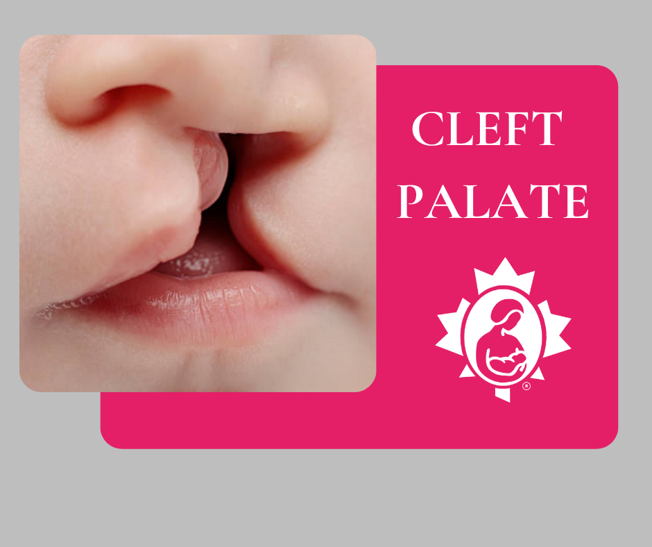 Feeding a Baby with a Cleft Lip and/or Cleft Palate La Leche League Canada Breastfeeding